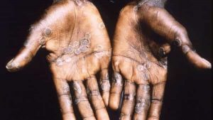 HEALTH-MONKEYPOX--2_1653826741580_1658844475834_1658844475834